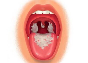 Diphtheria Cases at King’s College: Everything you should know