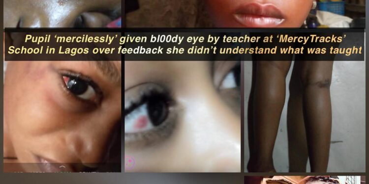 DEVELOPING STORY: MercyTracks Schools Teacher Allegedly Beats Pupil for Not Understanding Lesson, Parents Raise Alarm Over Child’s Eye Injury