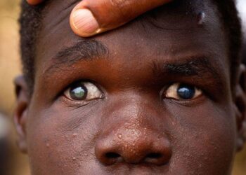 FG Moves to Improve Education Access for Visually Impaired Persons