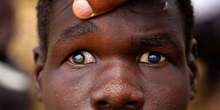 FG Moves to Improve Education Access for Visually Impaired Persons