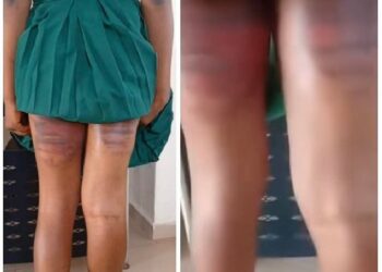 Call for justice after SS3 student was allegedly beaten brutally at Command secondary school lyana lpaja