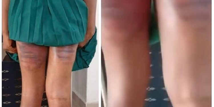 Call for justice after SS3 student was allegedly beaten brutally at Command secondary school lyana lpaja